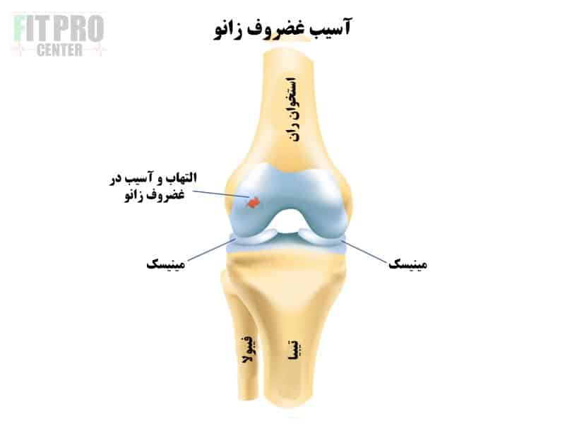 بررسی آسیب غضروف زانو در ورزشکاران کراسفیت