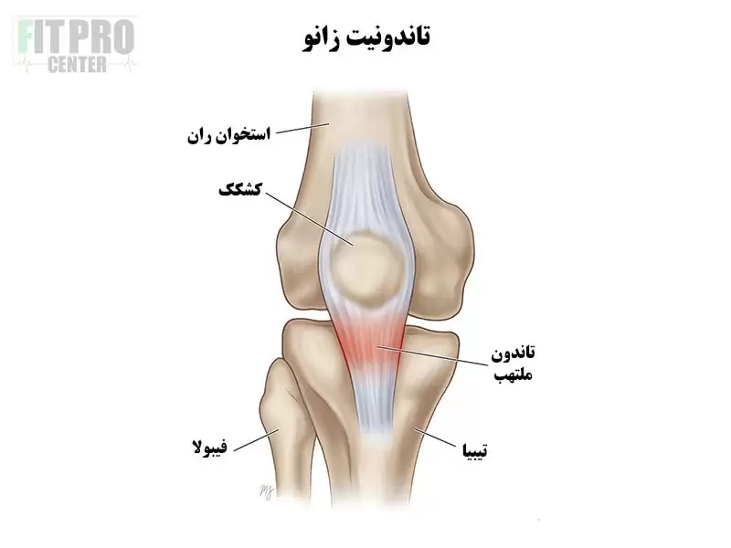تاندونیت زانو در ورزشکاران کراسفیت