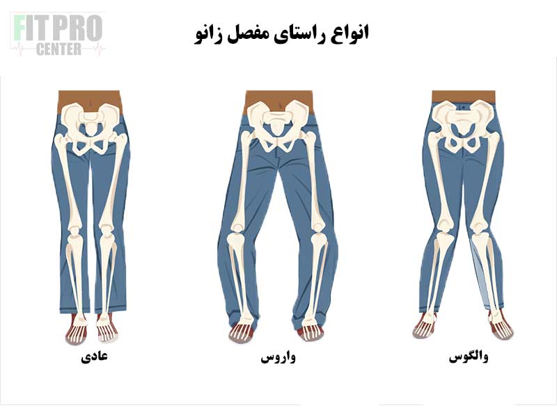 والگوس و واروس زانو در وزنه برداران و ورزشکاران کراسفیت