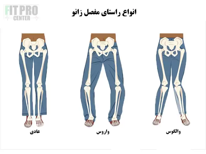 والگوس و واروس زانو در وزنه برداران و ورزشکاران کراسفیت